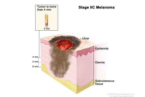 What is Stage II melanoma? - The Melanoma Nursing Initiative